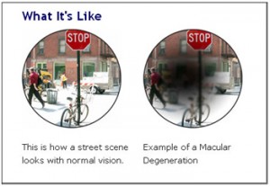 AMD-macular-degeneration-example